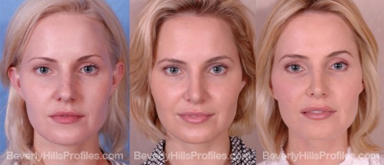 three photos before and after Rhinoplasty - front view