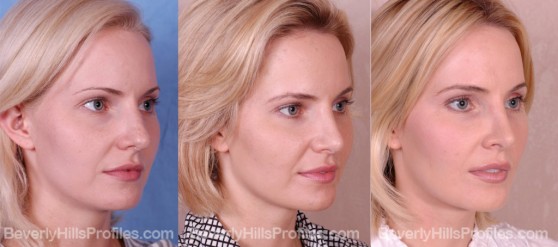 three photos before and after Rhinoplasty - oblique view