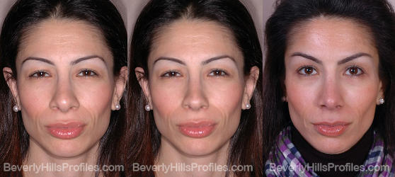 before and after revision rhinoplasty surgery front