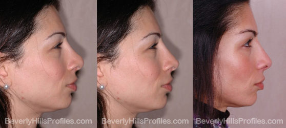 before and after revision rhinoplasty surgery profile
