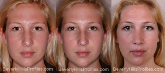 Female before after revision rhinoplasty surgery front