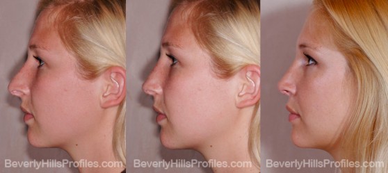 Female before after revision rhinoplasty surgery profile