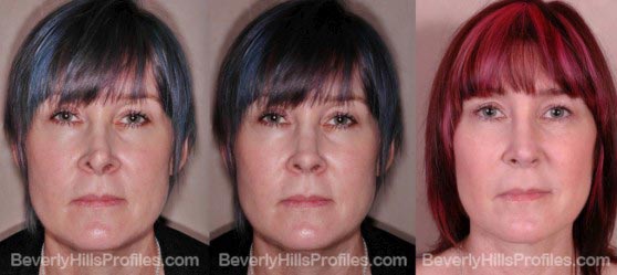 Female before and after revision rhinoplasty surgery front