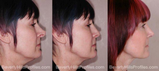 Female before and after revision rhinoplasty surgery profile