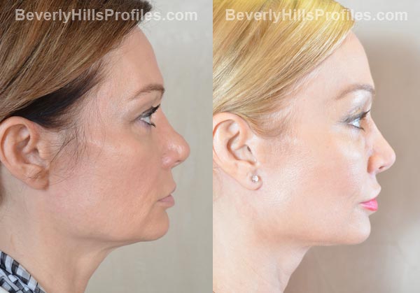 Female patient before and after Facelift - side view