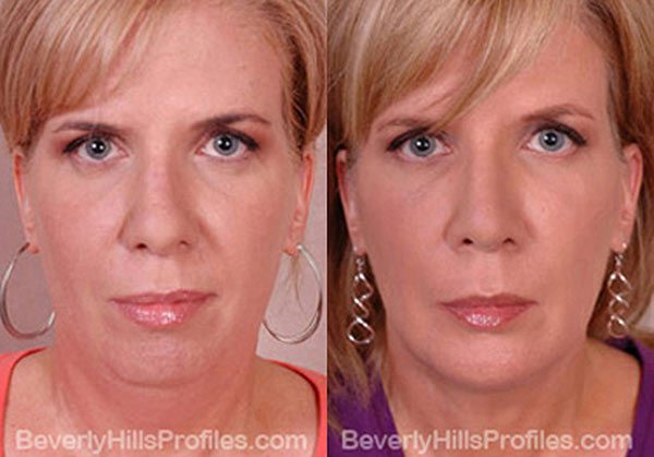 front view - Female patient before and after Facelift