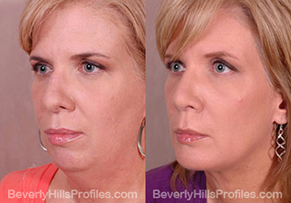 Woman's face, before and after Rhinoplasty treatment, r-side oblique view, patient 45