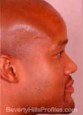 Male face After Septal Perforation treatment, right side view
