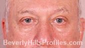 Blepharoplasty. Before Treatment Photo - male, front view, patient 1
