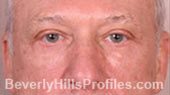 Blepharoplasty. After Treatment Photo - male, front view, patient 1
