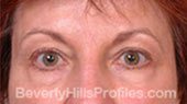 Blepharoplasty. Before Treatment Photo - female, front view, patient 2