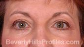 Blepharoplasty. After Treatment Photo - female, front view, patient 2