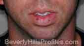 Chin Implants - Before Treatment Photo - male, front view, patient 1