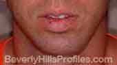 Chin Implants - After Treatment Photo - male, front view, patient 1