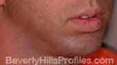 Chin Implants - After Treatment Photo - male, oblique view, patient 1