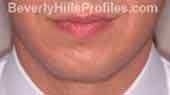 Chin Implants Before Treatment Photo - male, front view, patient 2
