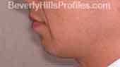 Chin Implants Before Treatment Photo - male, left side view, patient 2