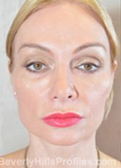 Female face, after Fat Grafting treatment, front view, patient 1