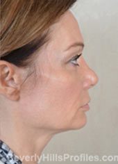 Female face, before Fat Grafting treatment, right side view, patient 1
