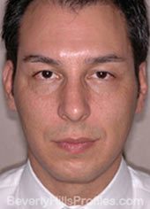 Male face - before Fat Grafting treatment, front view, patient 2