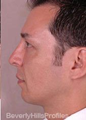 Male face - after Fat Grafting treatment, Left side view, patient 2