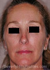 Female face, before Revision Facelifts treatment, front view, patient 1