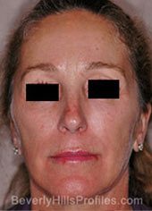 Mini-lift. Before Treatment Photo - female, front view, patient 1