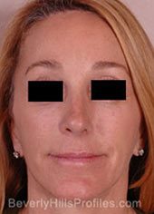 Female face, after Revision Facelifts treatment, front view, patient 1