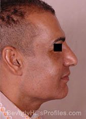 Male face, before Revision Facelifts treatment, right side view, patient 2