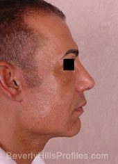 Male face, after Revision Facelifts treatment, right side view, patient 2