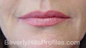 Photo After Injectable Filler Treatments