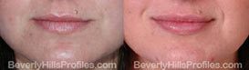 Photos Female patient before and after Wrinkle Treatments