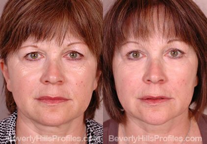 Female face, before and after Browlift treatment, front view, patient 2