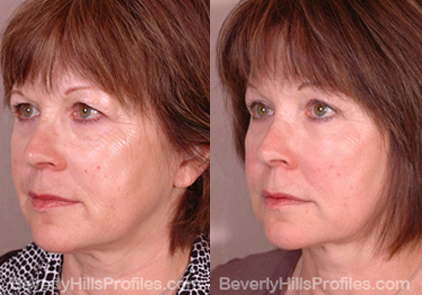 pics patient before and after Browlift