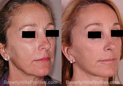 pics patient before and after Browlift Procedures