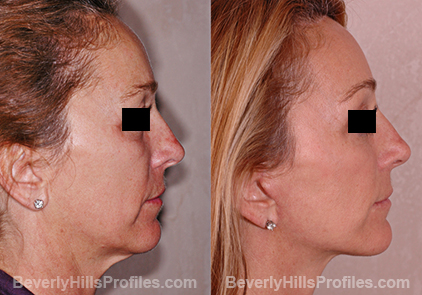 pics female before and after Browlift Procedures