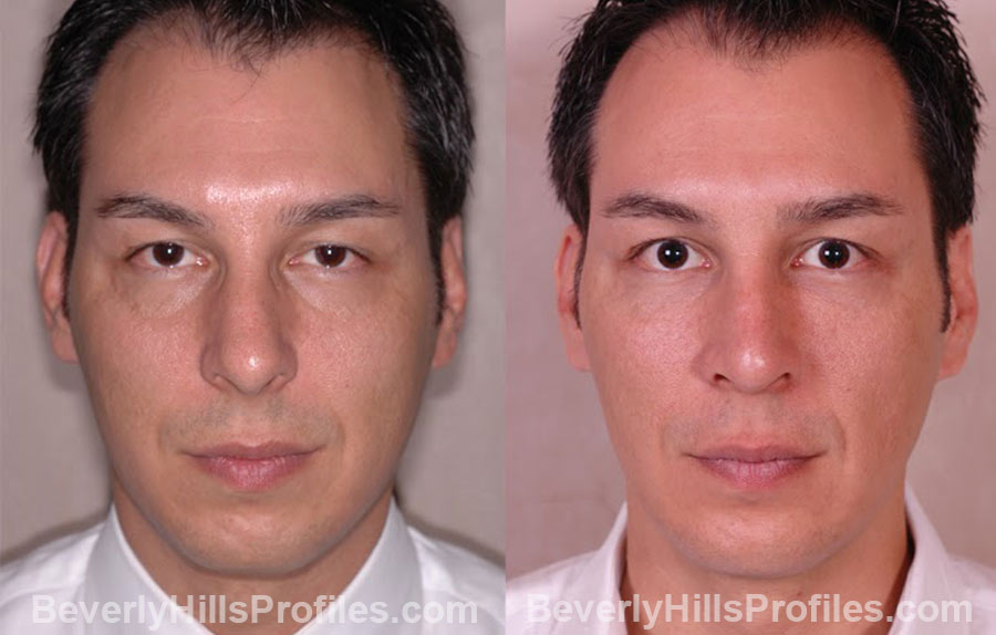 pics male patient before and after Chin Implants