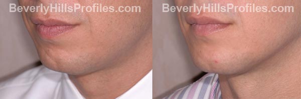 male patient before and after Chin Implants