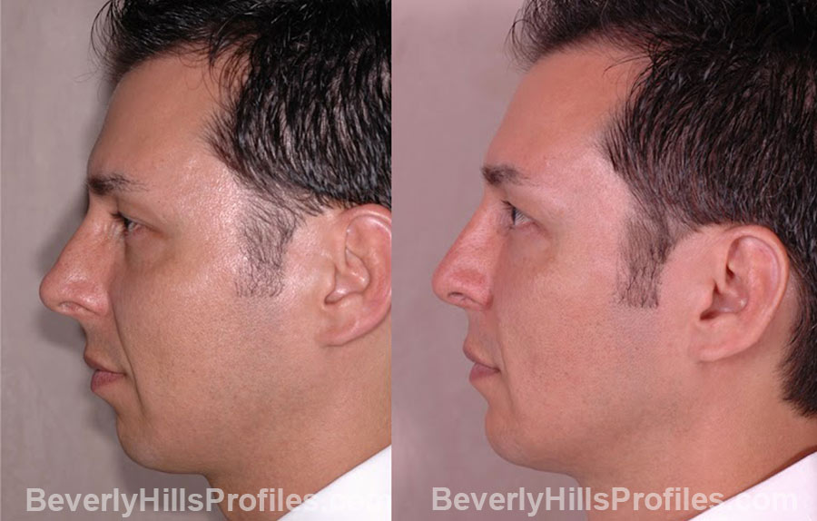 side view male patient before and after Chin Implants