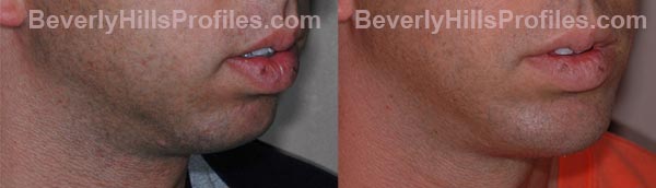 oblique view - Male before and after Chin Implants