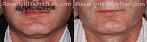 Male patient before and after Chin Implants - front view