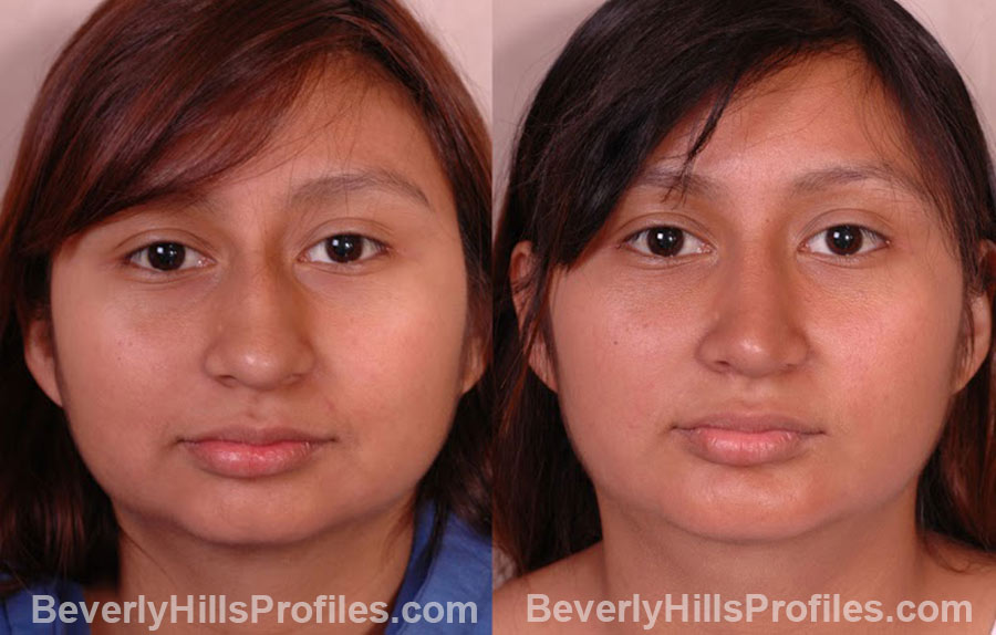 front view - before and after Chin Implants