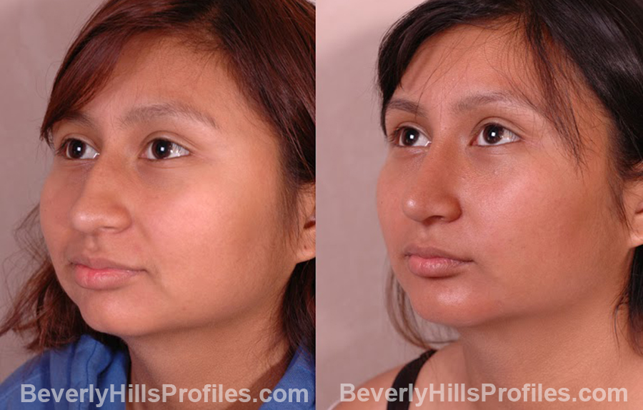 oblique view - before and after Chin Implants