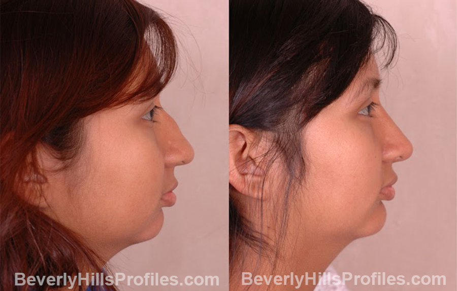 side view - before and after Chin Implants