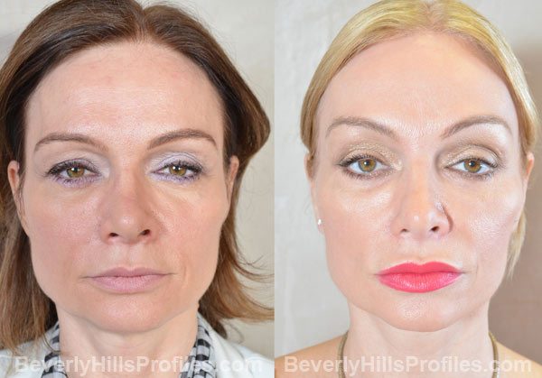 Female face, before and after Browlift treatment, front view, patient 3