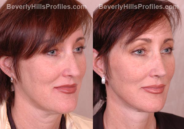 patient before and after Facelift - oblique view