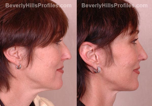 patient before and after Facelift - side view