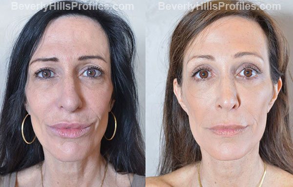 pics female patient before and after Facelift