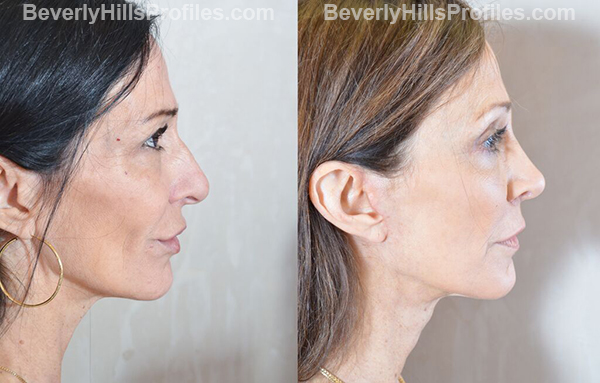 photos Female before and after Facelift - oblique view