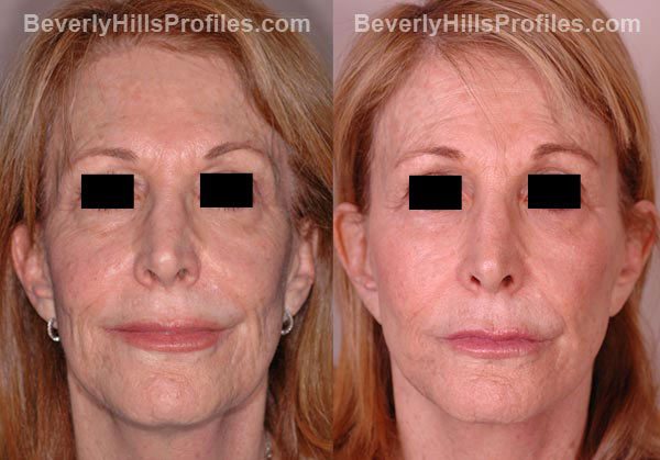 front view Female patient before and after Facelift